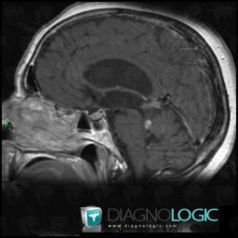 Tectal / peritectal glioma, Cerebral falx / Midline, MRI