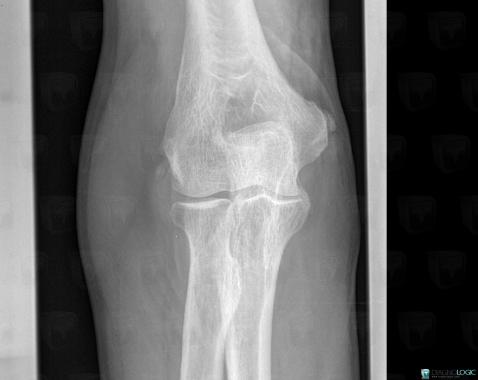 Cas Radiologie Tendinopathie Enth sopathie Coude Epicondyliens 