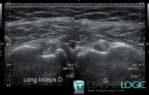 Tendinopathie / Epaule, Tendon-long biceps, Echographie