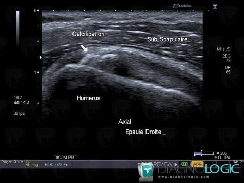 Tendinopathie / Epaule, Tendon sub scapulaire, Echographie