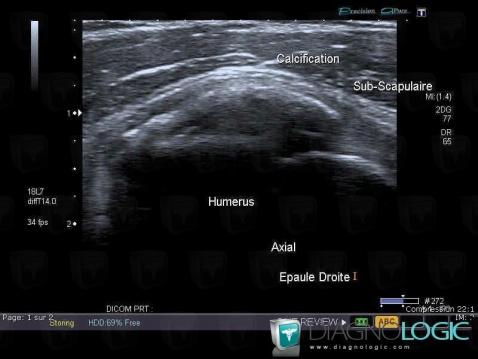Tendinopathie / Epaule, Tendon sub scapulaire, Echographie