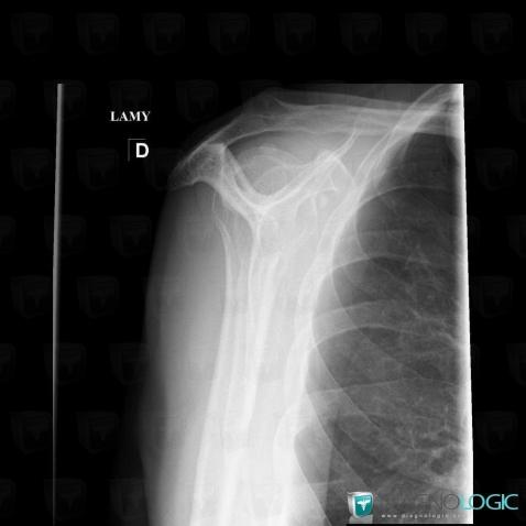 Tendinopathie / Epaule, Tendon sub scapulaire, Radio