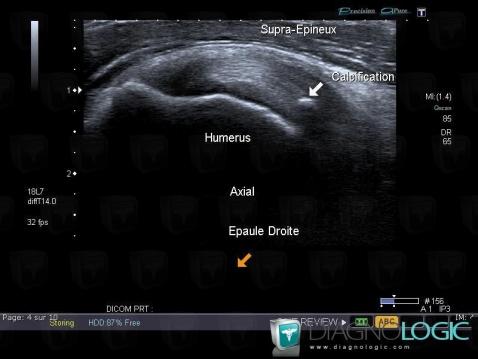 Tendinopathie / Epaule, Tendon supra épineux, Echographie