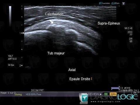 Tendinopathie / Epaule, Tendon supra épineux, Echographie