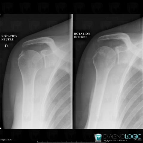 Tendinopathie / Epaule, Tendon supra épineux, Radio