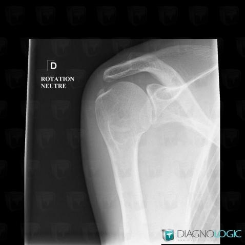 Tendinopathie / Epaule, Tendon supra épineux, Radio