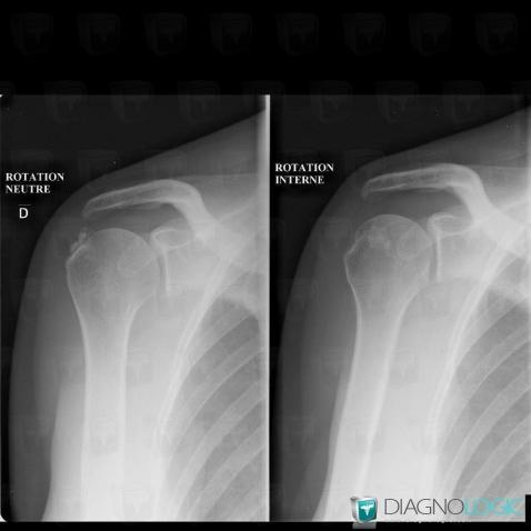 Tendinopathie / Epaule, Tendon supra épineux, Radio