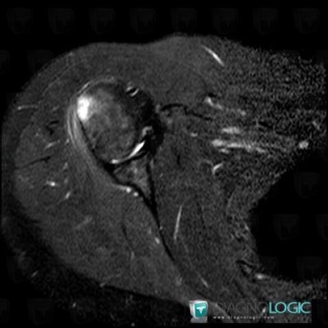 Tendinopathie / Epaule, Tendon teres minor, IRM