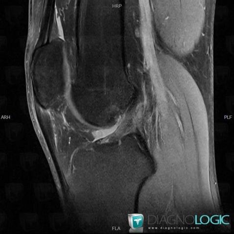 Tendinopathie patellaire, Tendon patellaire, IRM