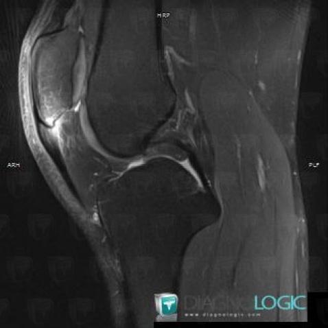 Cas radiologie : Tendinopathie patellaire (IRM) - Diagnologic