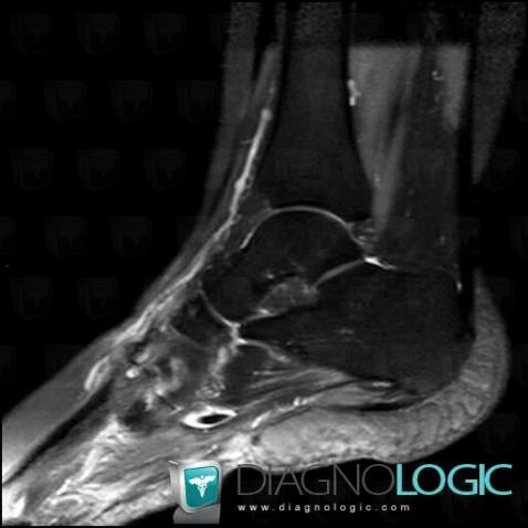 Tendinopathie - Ténosynovite Cheville / Fibulaire, Tendons fibulaires - Pied, IRM