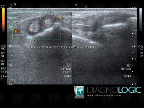 Tendinopathie - Ténosynovite Cheville / Tibial postérieur, Tendon tibial postérieur - Cheville, Echographie