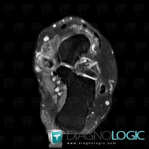 Tendinopathie - Ténosynovite Cheville / Tibial postérieur, Tendon tibial postérieur - Pied, IRM