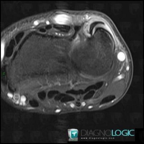 Tendinopathie - Ténosynovite Poignet / Extenseur ulnaire-carpe, Tendons/face dorsale - Poignet, IRM