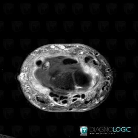 Tendinopathie - Ténosynovite Poignet / Extenseur ulnaire-carpe, Tendons/face dorsale - Poignet, IRM