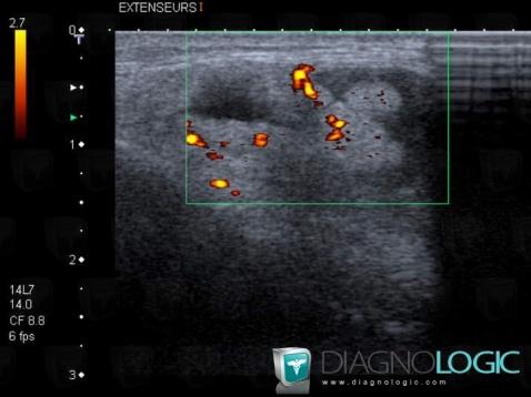 Tendinopathie - Ténosynovite Poignet - Main / Extenseurs-doigts, Tendons/face dorsale - Poignet, Echographie