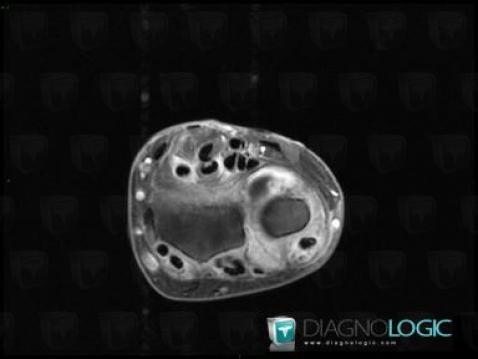 Tendinopathie - Ténosynovite Poignet - Main / Extenseurs-doigts, Tendons/face dorsale - Poignet, IRM
