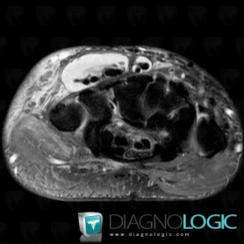 Tendinopathie - Ténosynovite Poignet - Main / Extenseurs-doigts, Tendons/face dorsale - Poignet, IRM