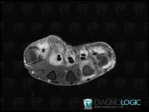 Tendinopathie - Ténosynovite Poignet - Main / Fléchisseurs-doigts, Tendons/face palmaire - Main, IRM