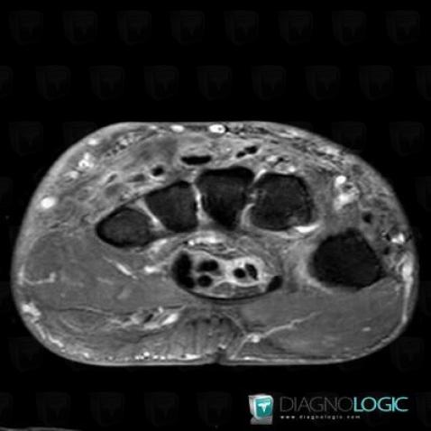 Tendinopathie - Ténosynovite Poignet - Main / Fléchisseurs-doigts, Tendons/face palmaire - Poignet, IRM