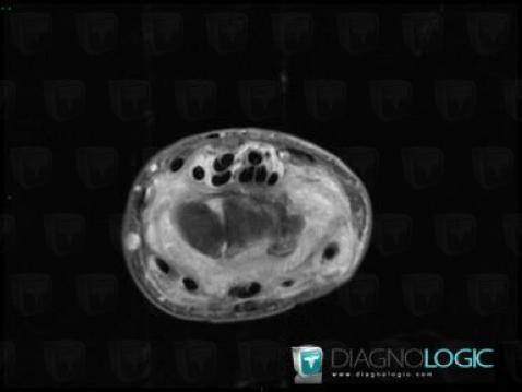 Tendinopathie - Ténosynovite Poignet - Main / Long fléchisseur-pouce, Tendons/face palmaire - Poignet, IRM