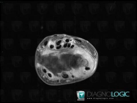 Tendinopathie - Ténosynovite Poignet - Main / Tendons-radiaux, Tendons/face dorsale - Poignet, IRM