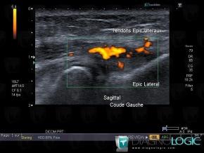 Tendinopathy - enthesopathy Elbow  / Epicondyle, Lateral epicondyle muscles, US