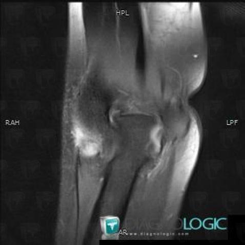 Tendinopathy - enthesopathy Elbow  / Epicondyle, Medial epicondyle muscles, MRI