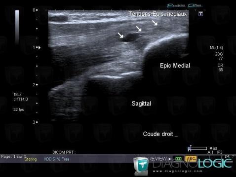 Tendinopathy - enthesopathy Elbow  / Epicondyle, Medial epicondyle muscles, US