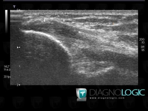 Tendinopathy - enthesopathy Elbow  / Epicondyle, Medial epicondyle muscles, US