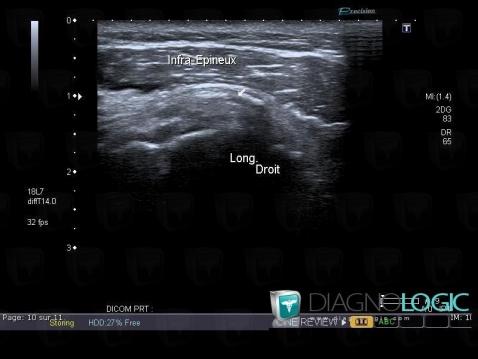 Tendinopathy / Shoulder, Infraspinatus tendon, US