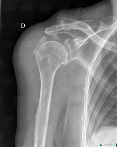 Tendinopathy / Shoulder, Other soft tissues/nerves - Shoulder, X rays