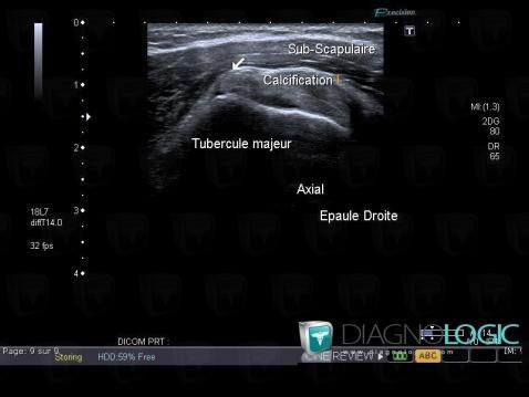 Tendinopathy / Shoulder, Sub scapularis tendon, US