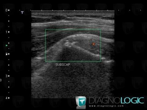 Tendinopathy / Shoulder, Sub scapularis tendon, US