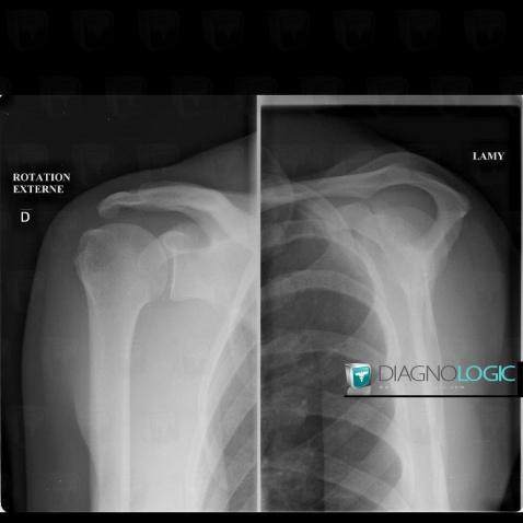 Tendinopathy / Shoulder, Sub scapularis tendon, X rays