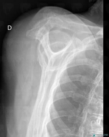 Tendinopathy / Shoulder, Sub scapularis tendon, X rays