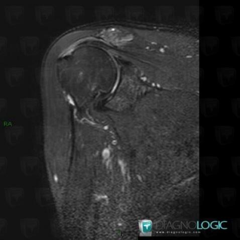 Tendinopathy / Shoulder, Supraspinatus tendon, MRI