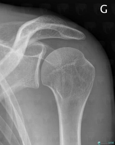 Tendinopathy / Shoulder, Supraspinatus tendon, X rays