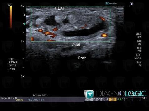 Tendinopathy - Tenosynovitis Ankle  / Extensor digitorum longus , Other tendons - Ankle, US