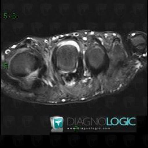 Tendinopathy - Tenosynovitis Ankle  / Flexor digitorum longus , Other tendons - Foot, MRI