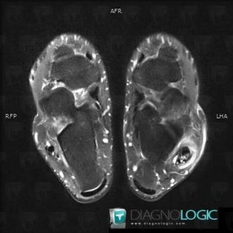 Tendinopathy - Tenosynovitis Ankle / Peroneal tendons, Fibularis tendons - Ankle, MRI