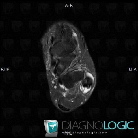 Tendinopathy - Tenosynovitis Ankle / Peroneal tendons, Fibularis tendons - Ankle, MRI