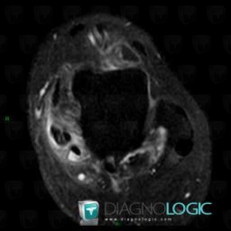 Tendinopathy - Tenosynovitis  Ankle / Tibialis posterior, Tibialis posterior tendon - Ankle, MRI