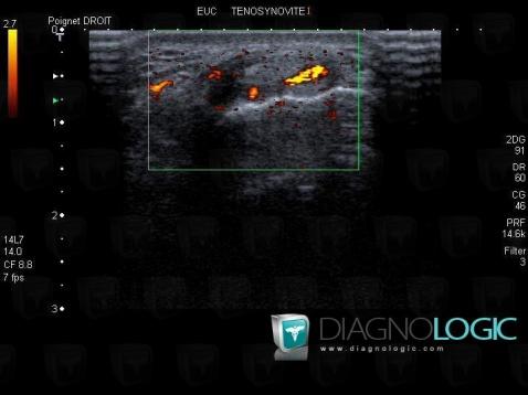 Tendinopathy - Tenosynovitis Wrist / Extensor carpi ulnaris , Tendons/dorsal side - Hand, US