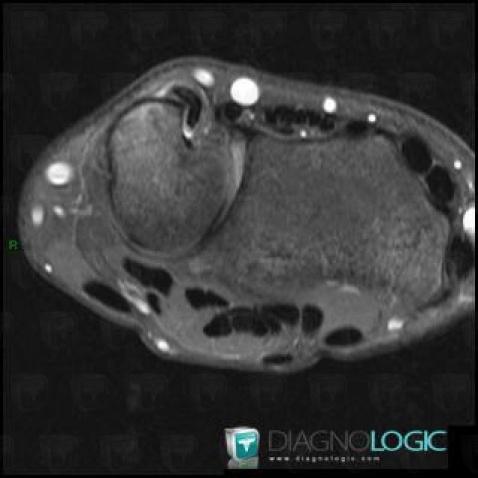 Tendinopathy - Tenosynovitis Wrist / Extensor carpi ulnaris , Tendons/dorsal side - Wrist, MRI