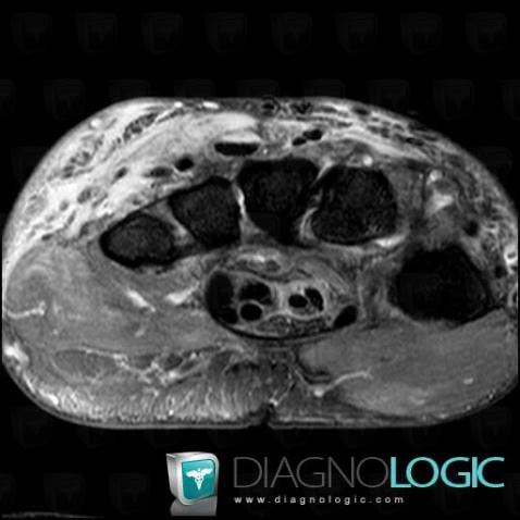 Tendinopathy - Tenosynovitis Wrist - Hand / finger extensor, Tendons/dorsal side - Hand, MRI