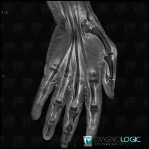 Tendinopathy - Tenosynovitis Wrist - Hand / finger extensor, Tendons/dorsal side - Wrist, Tendons/dorsal side - Hand, MRI