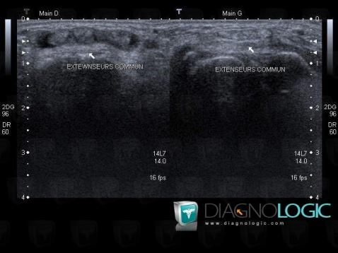 Tendinopathy - Tenosynovitis Wrist - Hand / finger extensor, Tendons/dorsal side - Wrist, US