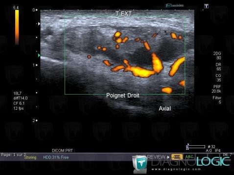 Tendinopathy - Tenosynovitis Wrist - Hand / finger extensor, Tendons/dorsal side - Wrist, US