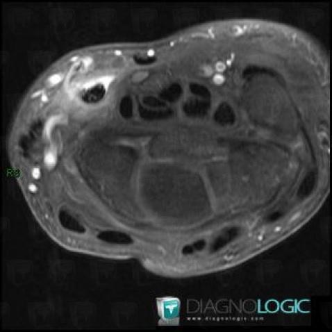 Tendinopathy - Tenosynovitis Wrist - Hand / Flexor carpi radialis, Tendons/palmar side - Wrist, MRI